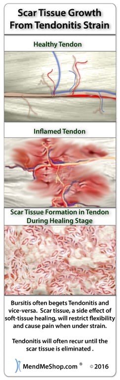 bursitis and tendinitis commonly occur together