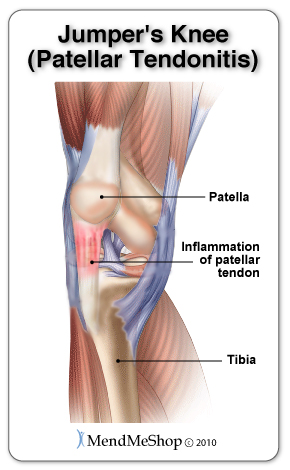 Patellar tendinitis refers to pain and inflammation of the patellar tendon in the kneecap
