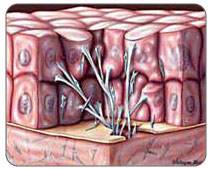 Scar tissue develops as damaged biceps tissue heals. This can lead to re-injury or other painful conditions if left untreated.