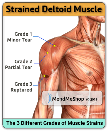Strained deltoid deals