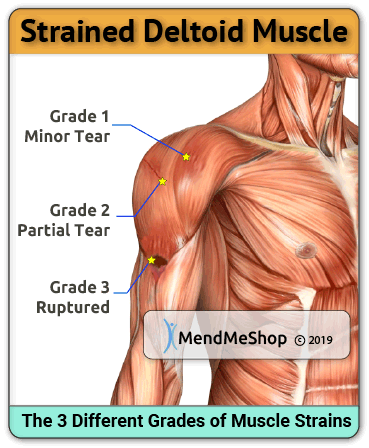 deltoid muscle strain grade