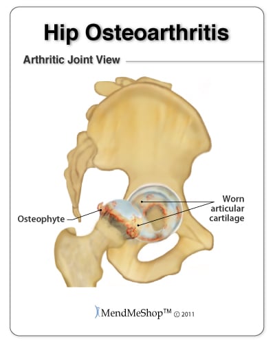 Osteoarthritis in the hip joint causes pain and stiffness in the front of the hip.