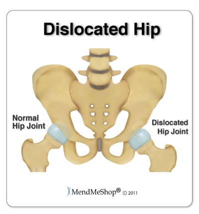 Hip displacement hotsell