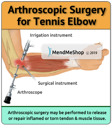 visual illustration tennis elbow arthroscopic surgery