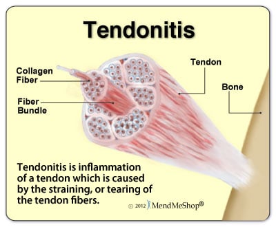 Tendonitis pain and inflammation.