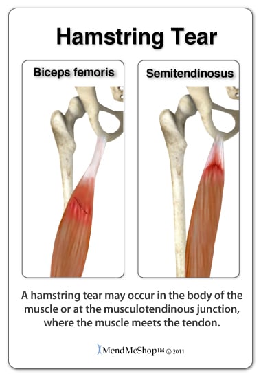 common torn hamstring locations