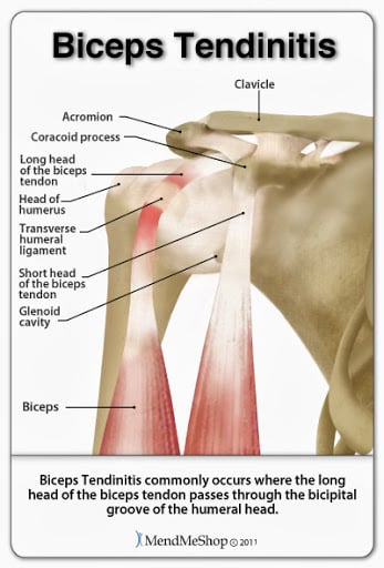 Bicep tendonitis, causing pain in the front of you shoulder