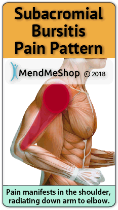 Subacromial Bursitis Pain Pattern