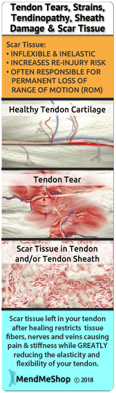 Scar tissue grows to protect your achilles injury but reduces mobility