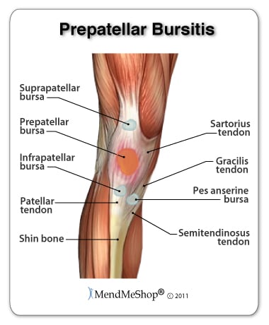 Pre-patellar bursitis is a real pain in the knee.