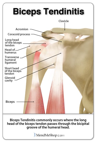 long head biceps brachii tendon tenonitis