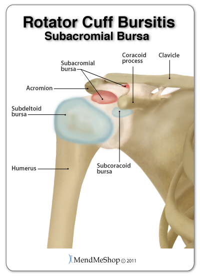Shoulder bursitis usually occurs in the subacromial bursa as it is at most risk to irritation due to its location. Other bursa in the rotator cuff area include the subdeltoid and subcoracoid bursae.