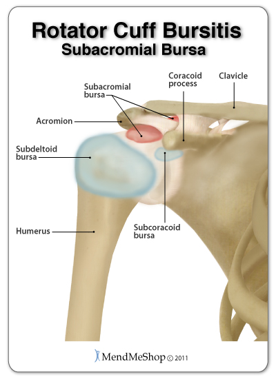 I Have Bursitis. So What Does That Mean?