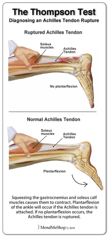 Thompson Test to determine if Achilles tendon is ruptured - When calf muscles squeezed, the foot should go into plantarflexion if Achilles tendon is intact