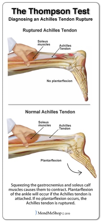 doctors use Thompson Test to determine if Achilles is ruptured