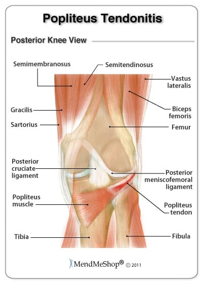 Popliteus Tendinitis Symptoms Causes Diagnosis Treatments