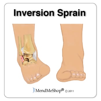 A common cause of peroneal tendonitis is the stretching of the tendons during an inversion sprain or rolling over on your ankle.