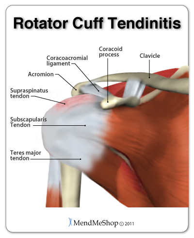 rotator cuff tendon tear visual anatomy
