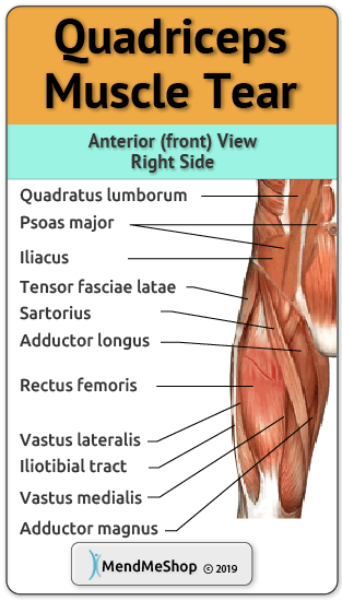 Quadriceps Muscle Strain