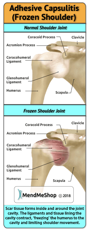 Adhesive capsulitis is scar tissue in shoulder joint rotator cuff causing shoulder to be immobile or frozen