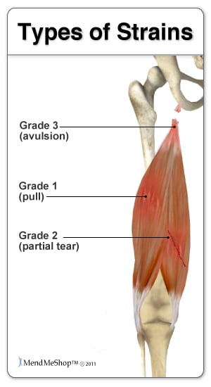 types of hamstring strain, hamstring muscle strain grading