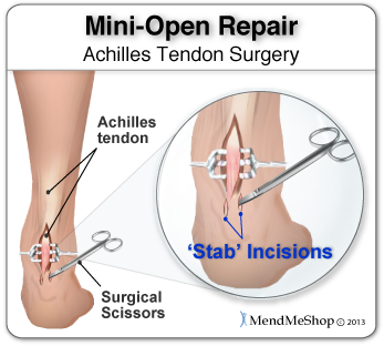 During a mini-open Achilles tendon repair surgery, 2 to 8 small stab incisions are made to pull the edges of the tendon tear together and suture the torn edges to repair the damage.