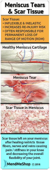 Soft tissue tears heal with  brittle, inflexible scar tissue