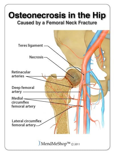 Osteonecrosis in the femoral head