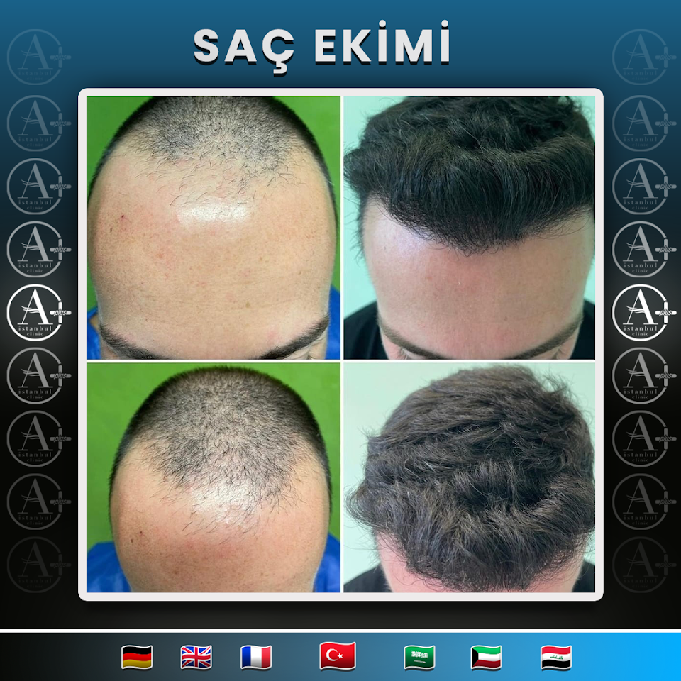 Mediavrupa Saç Ekim | Hair Transplant Turkey Istanbul | Saç Ekim Merkezi İstanbul | FUE Saç Ekimi | DHİ Saç Ekimi |