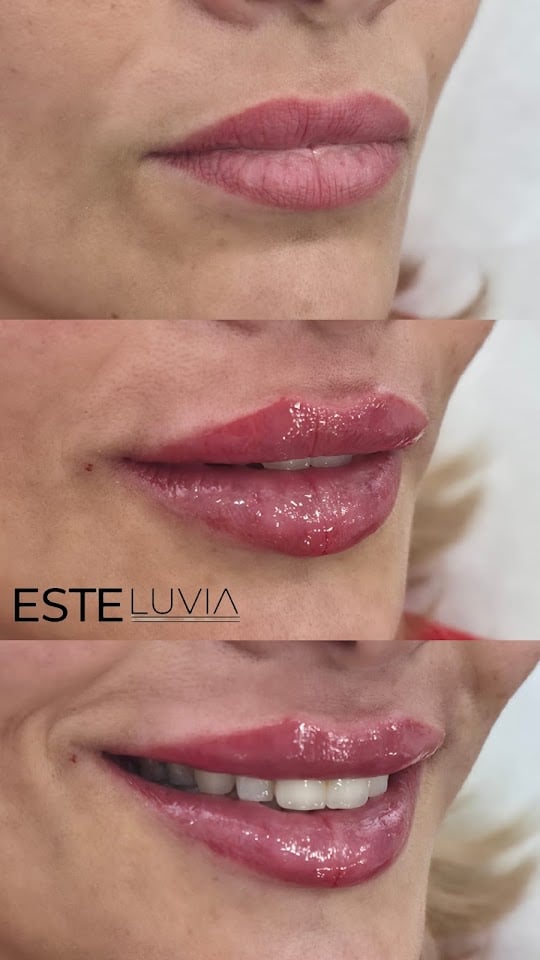 Esteluvia Estetik | Şişli Medikal Estetik | Dudak Dolgusu | Botoks | Sıvı Yüz Germe | Mezoterapi