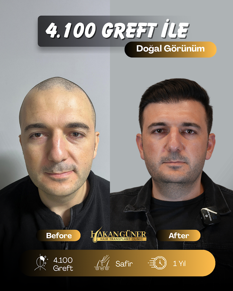 İzmir Saç Ekimi Merkezi - Hakan Güner