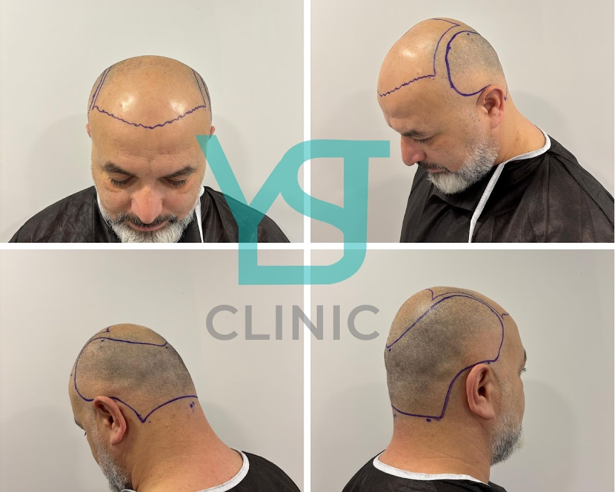 YST | Saç Ekimi - YST Hair Transplant Center
