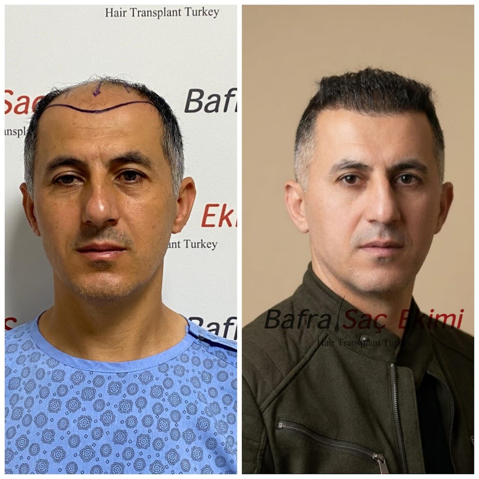 Samsun Saç Ekimi - Bafra Saç Ekimi