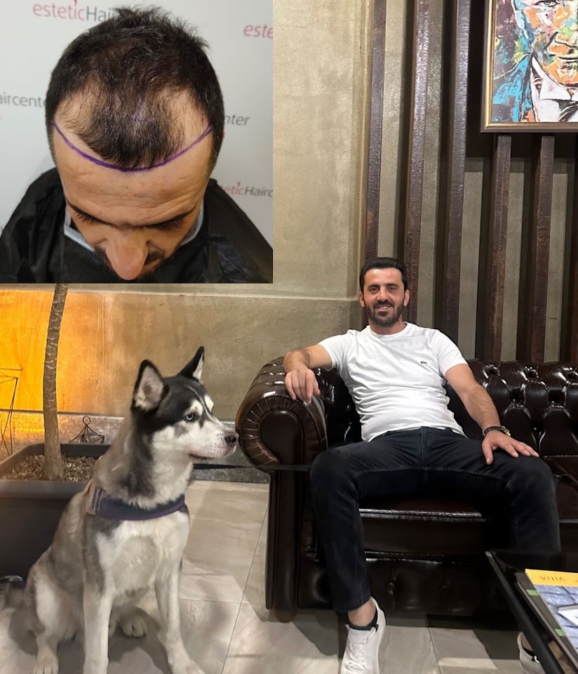 Estetichaircenter Saç Ekimi Saç Simülasyonu Bursa