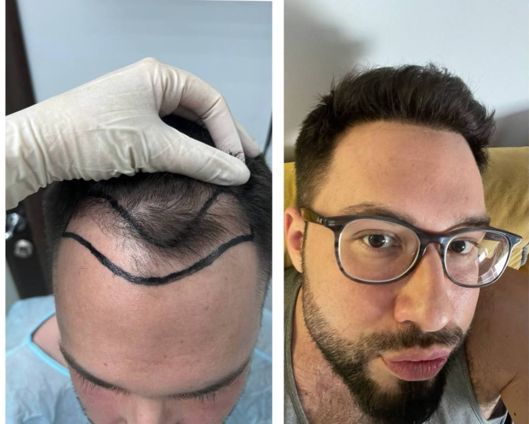 Gaziantep Fue Saç Ekim - Docshair Arif UĞUR