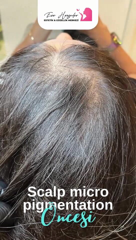 Ece Hoşgüler Estetik Güzellik SMP ( Kıl Kökü Görünümü Tekniği) Merkezi