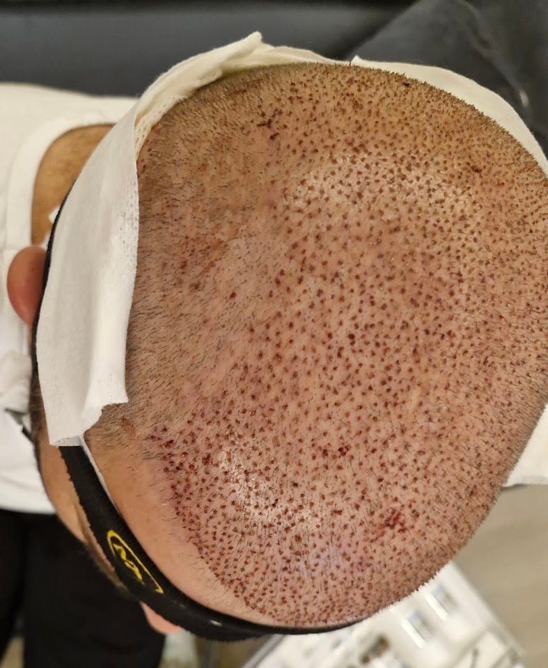 İzmir saç ekim merkezi maxhairclinic / maxhairizmir/saç ekim İzmir