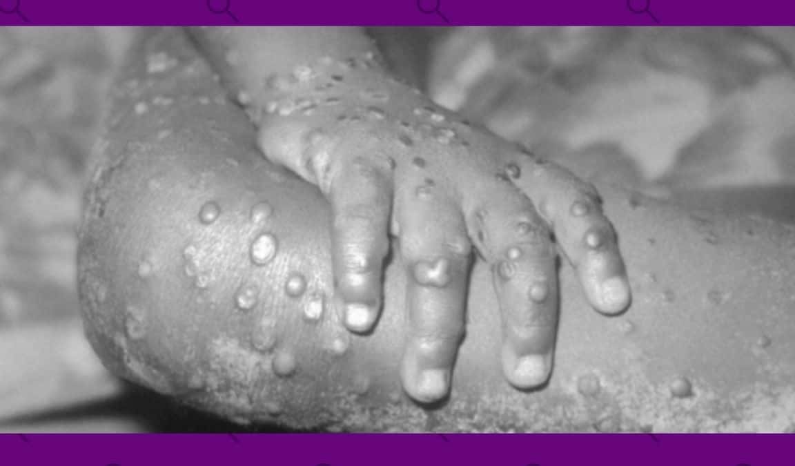 Viruela del mono: ¿qué es, cómo se transmite y hasta qué punto supone un riesgo?