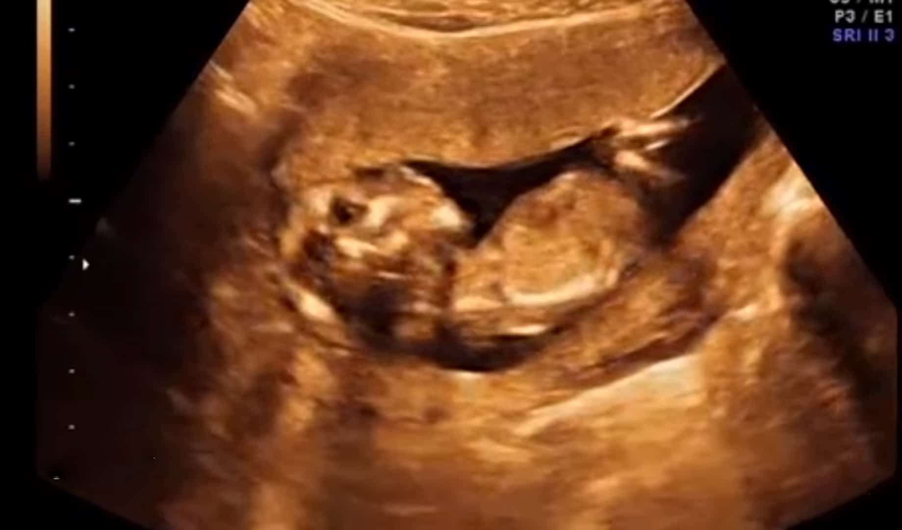 aborto en cuba ultrasonido de feto