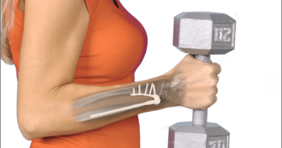 Aptis DRUJ prosthesis functional overlay
