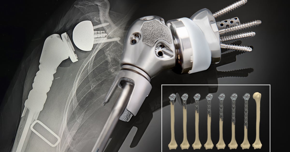 Equinoxe shoulder reconstruction prosthesis