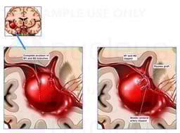Brain Surgery - Middle Cerebral Artery Aneurysm Repair