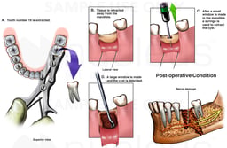 Surgical Drainage of Mandubular Abscess with Subsequent Nerve Damage