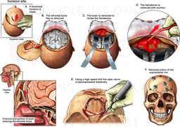 Brain Surgery - Craniotomy Procedure to Remove a Hematoma