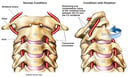 Rotational Injury of the Vertebral Artery