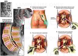 Cyst within Spinal Canal and Surgical Removal