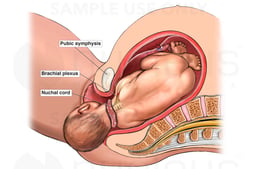 Birth Injury - Shoulder Dystocia with Right Brachial Plexus Injury Caused by Pubic Symphysis