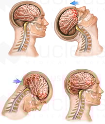 Whiplash - Front to Back Closed Head Injury