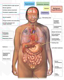Medical Condition Including Hypertension and Papilledema