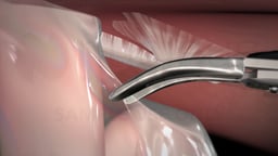 Laparoscopic Repair of Ventral Incisional Hernias